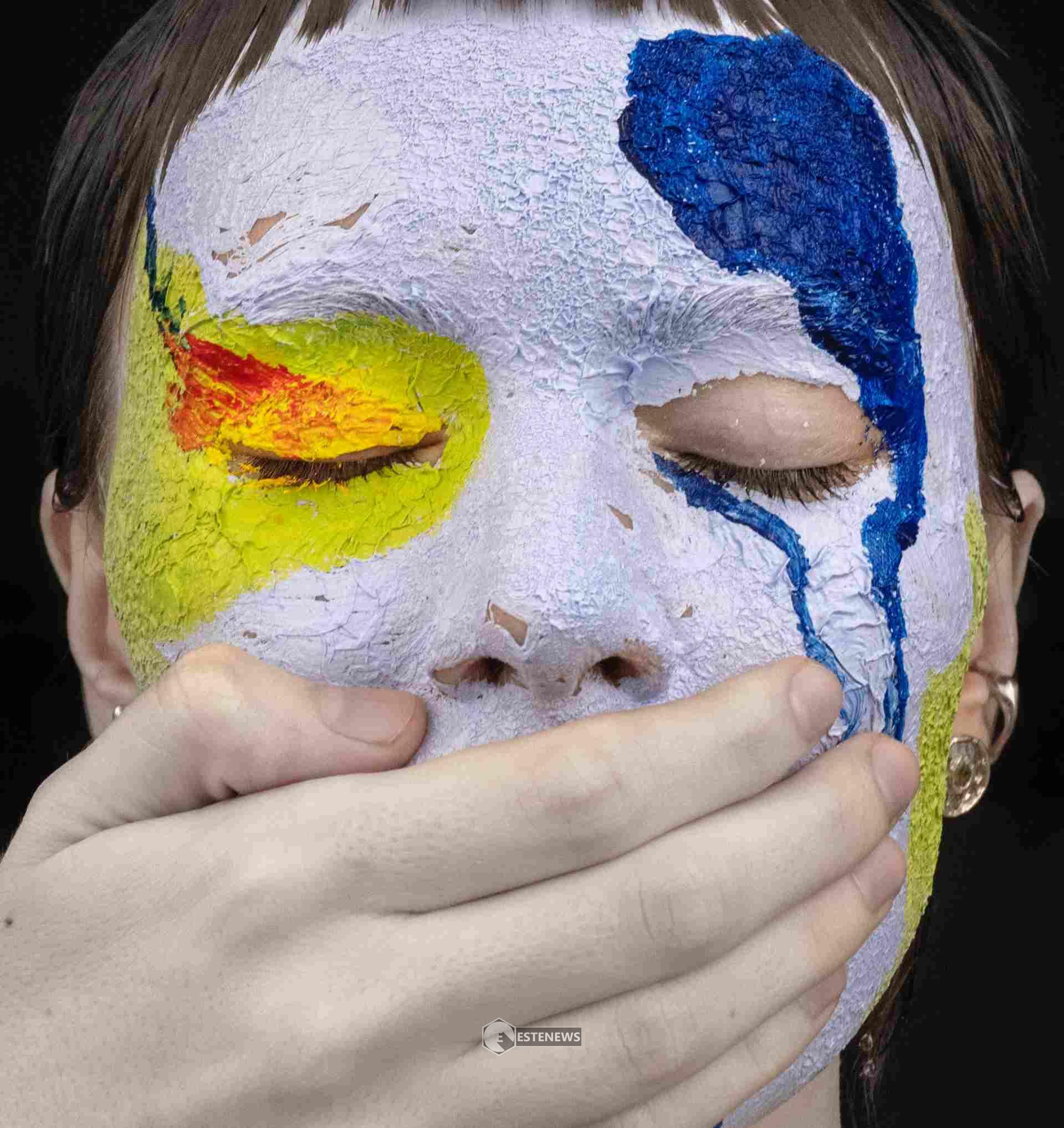 Sindrome accento straniero